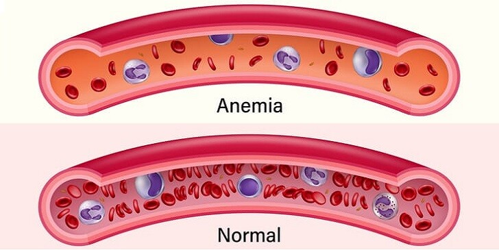 Anemia Quiz: How Much Do You Know About This Condition?