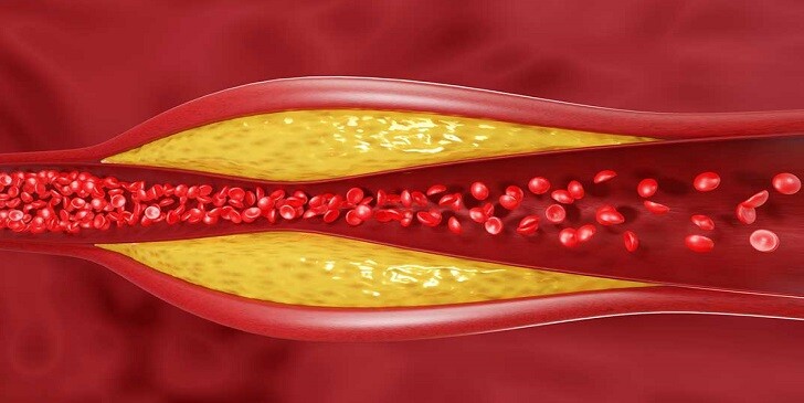 Cholesterol Quiz: How Healthy Is Your Heart