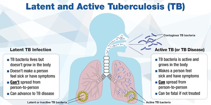 Tuberculosis Quiz: How Much Do You Really Know?